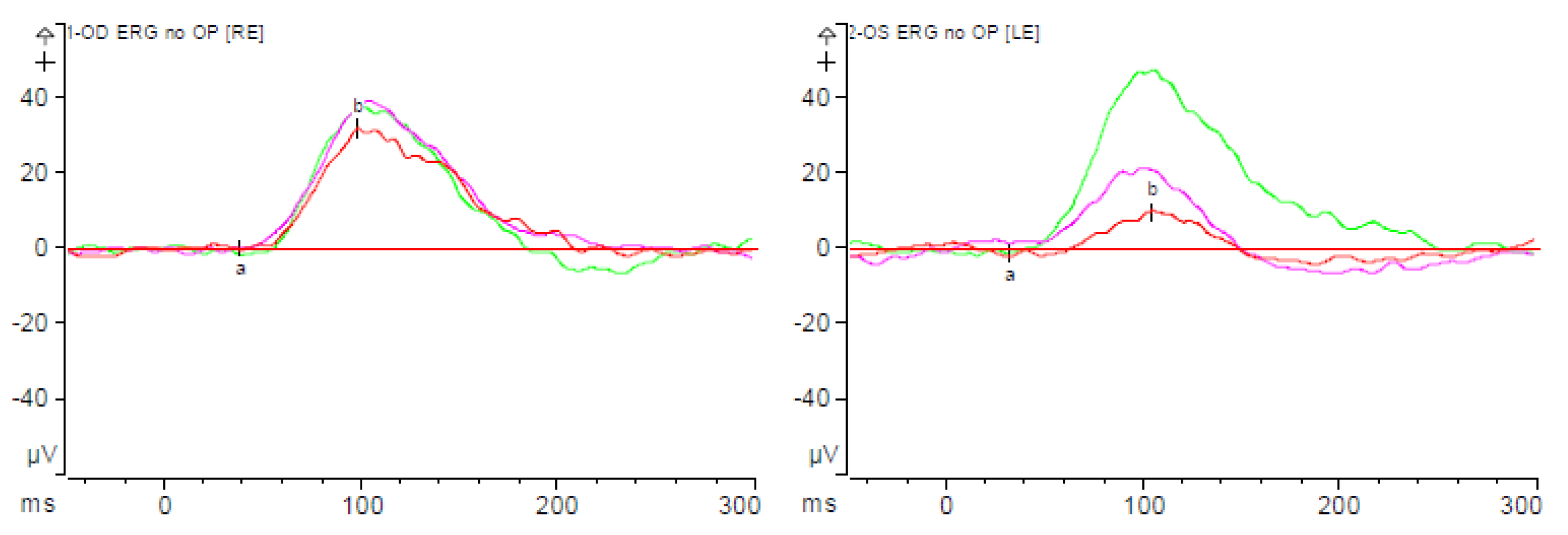 Scotopic Threshold Response (STR)